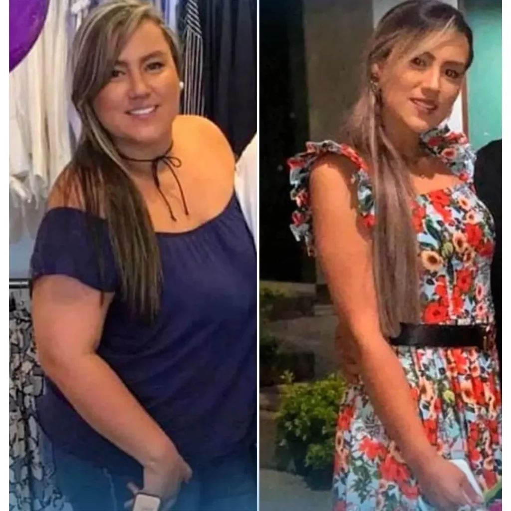 Antes y Después de Cirugía Bariátrica - Dr Rubén Luna Cirujano Bariátrico en Bogotá -ALT