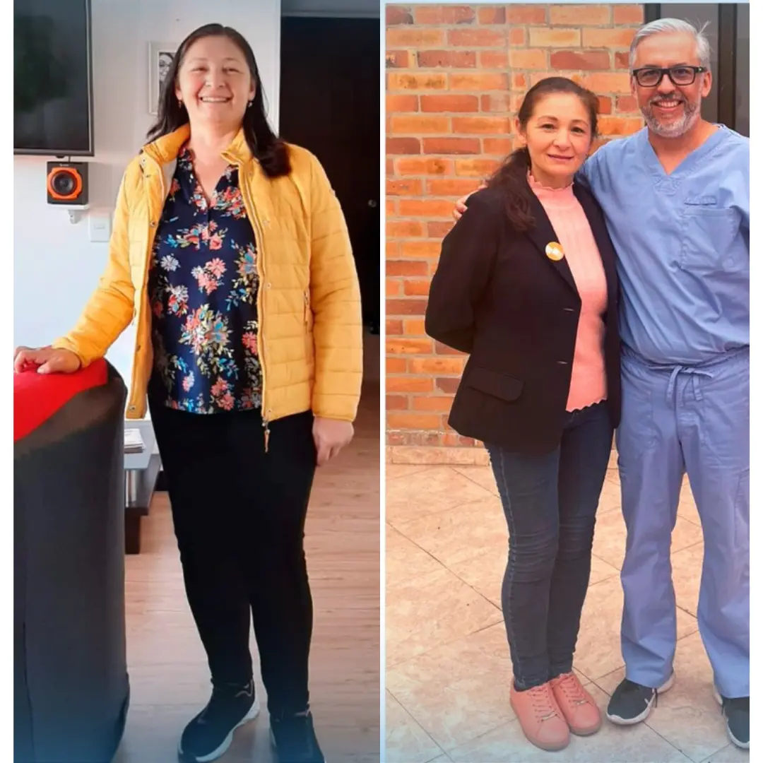 Antes y Después de Cirugía Bariátrica - Dr Rubén Luna Cirujano Bariátrico en Bogotá -ALT 3