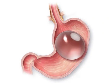 Gastric ballon requirements for bariatric surgery