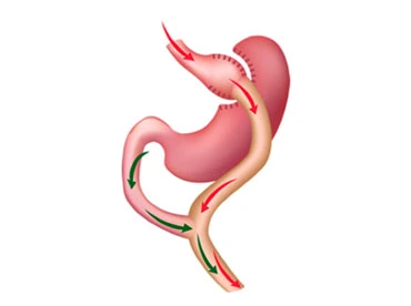 Gastric bypass requirements for bariatric surgery