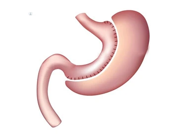 gastric sleeve requirements for bariatric surgery