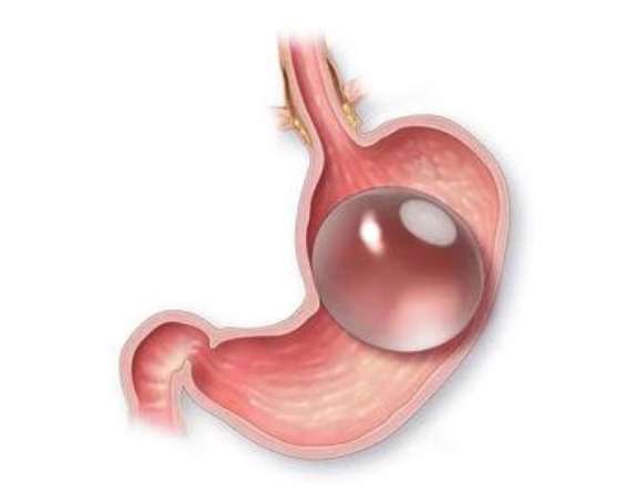 What is Gastric Ballon