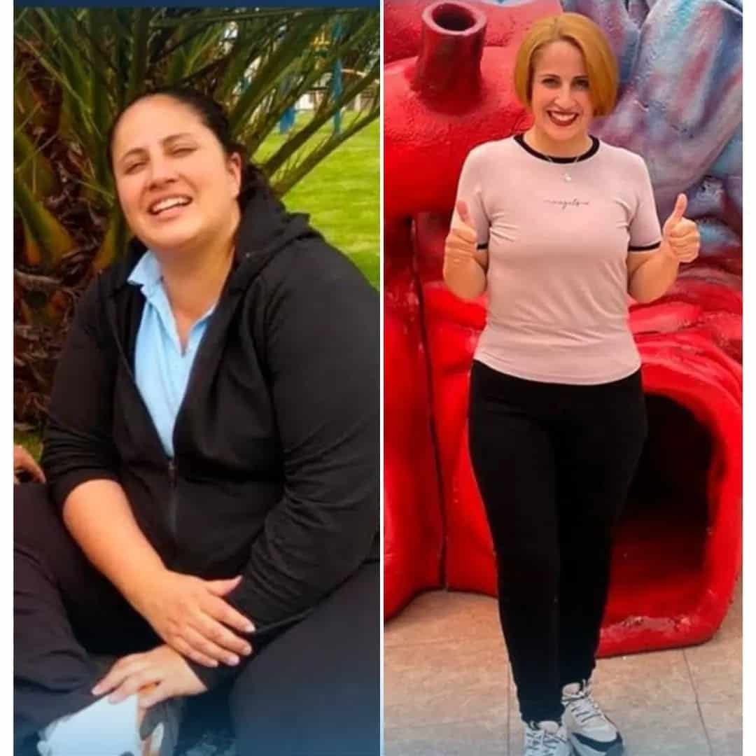Gastric Sleeve 101 Before and after