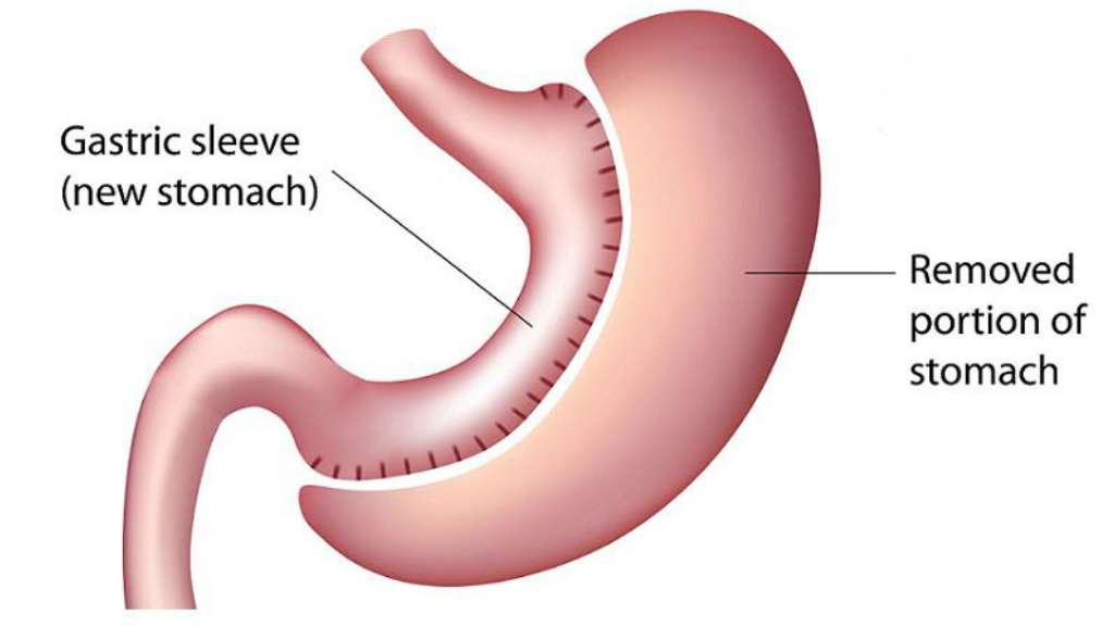 Gastric Sleeve 101 Dr. Ruben Luna, a renowned bariatric surgeon in Colombia