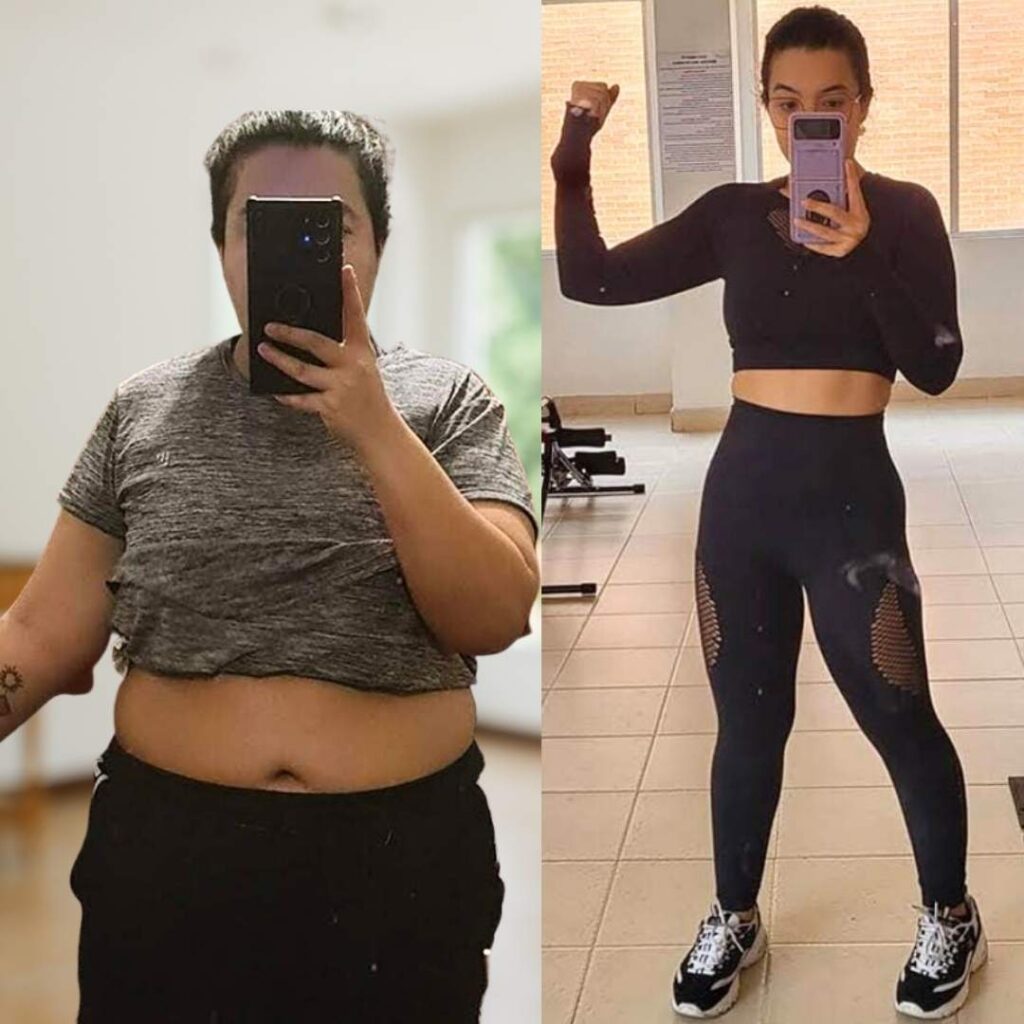 Antes y Después de Cirugía Bariátrica - Dr Rubén Luna Cirujano Bariátrico en Bogotá -ALT