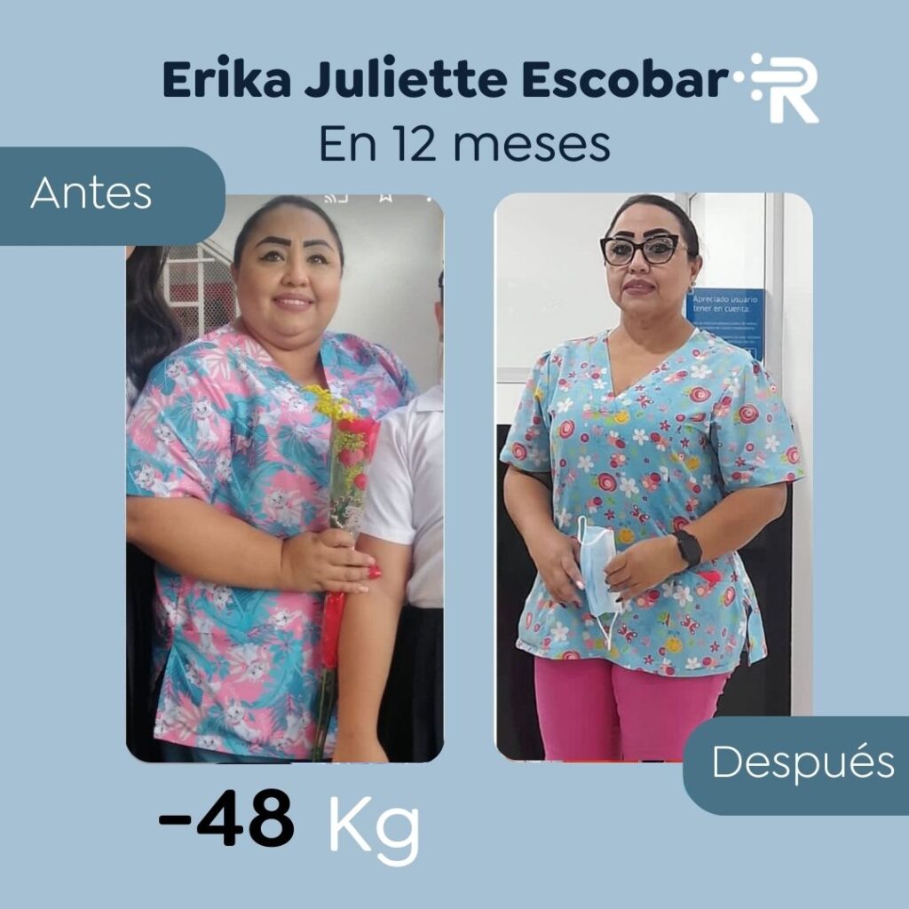 ANTES Y DESPUES Erika Escobar dr RUBEN LUNA