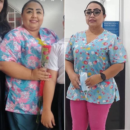 Cirugía bariátrica antes y después fotos