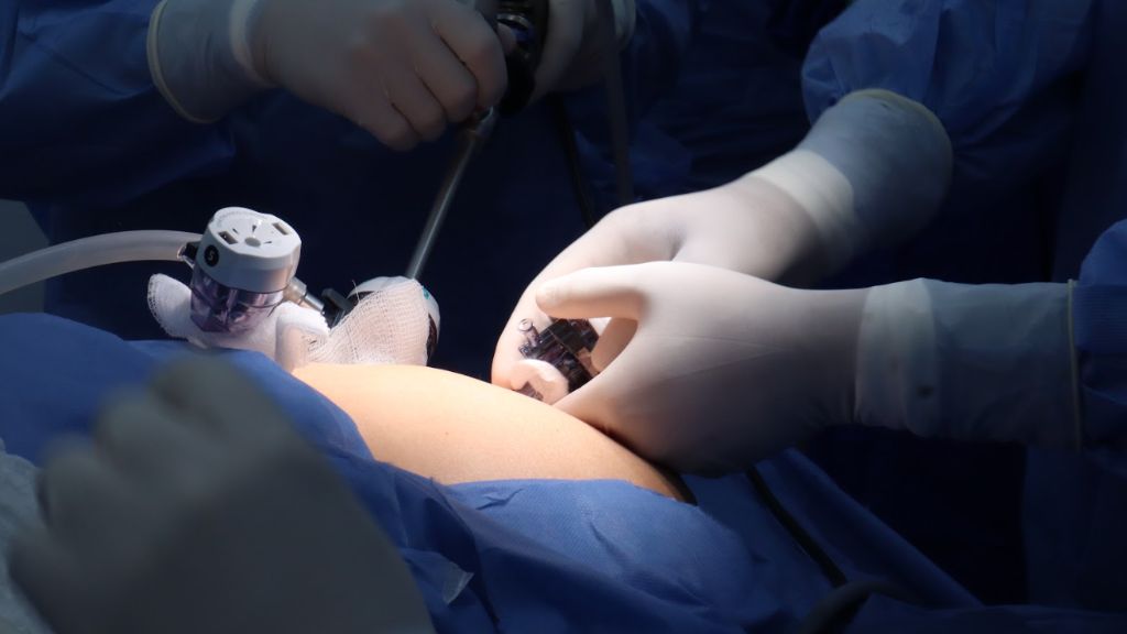 Cirugía bariátrica el tratamiento más efectivo contra la obesidad