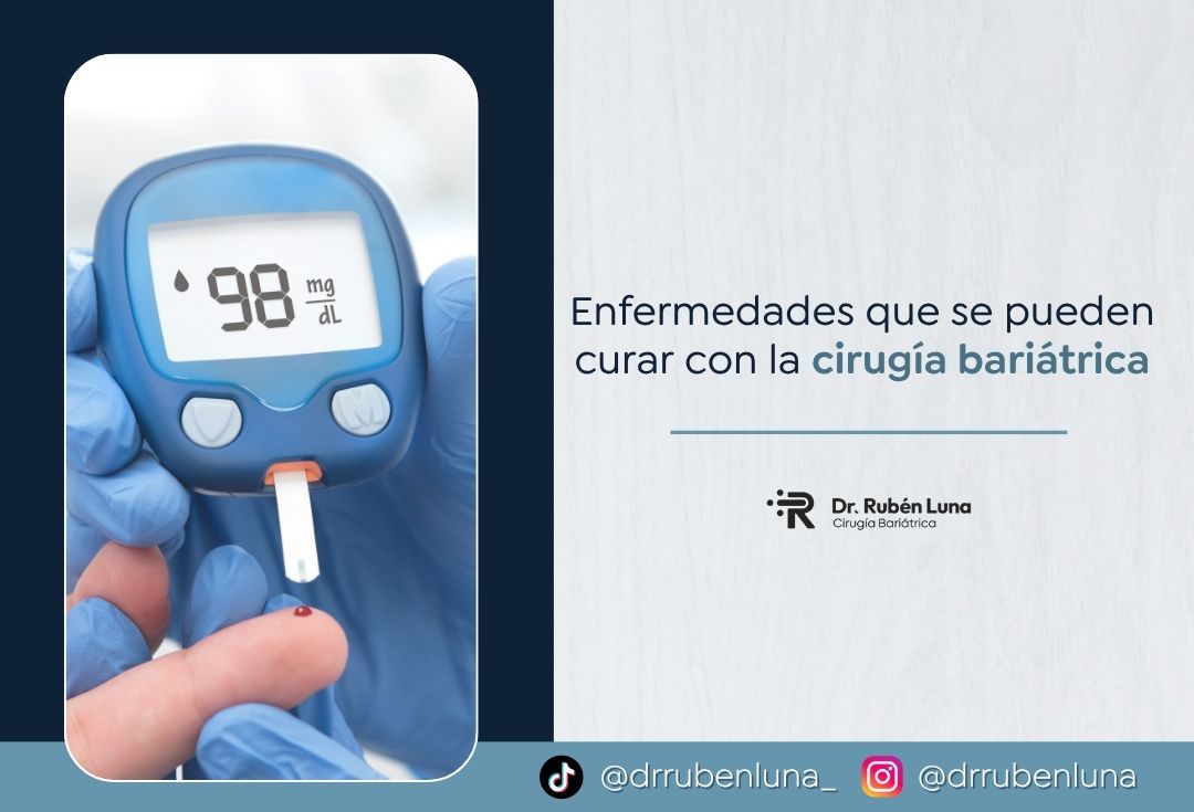 Comorbilidades que trata la cirugía bariátrica - Dr. Rubén Luna