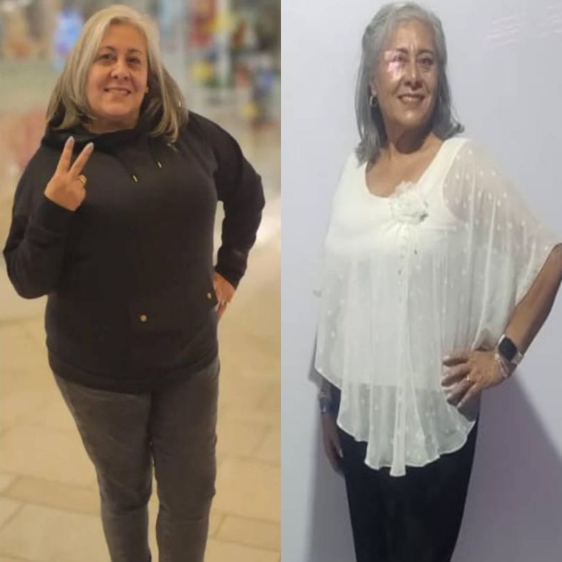 Antes y Después de Cirugía Bariátrica - Dr Rubén Luna Cirujano Bariátrico en Bogotá -ALT 5 (3)