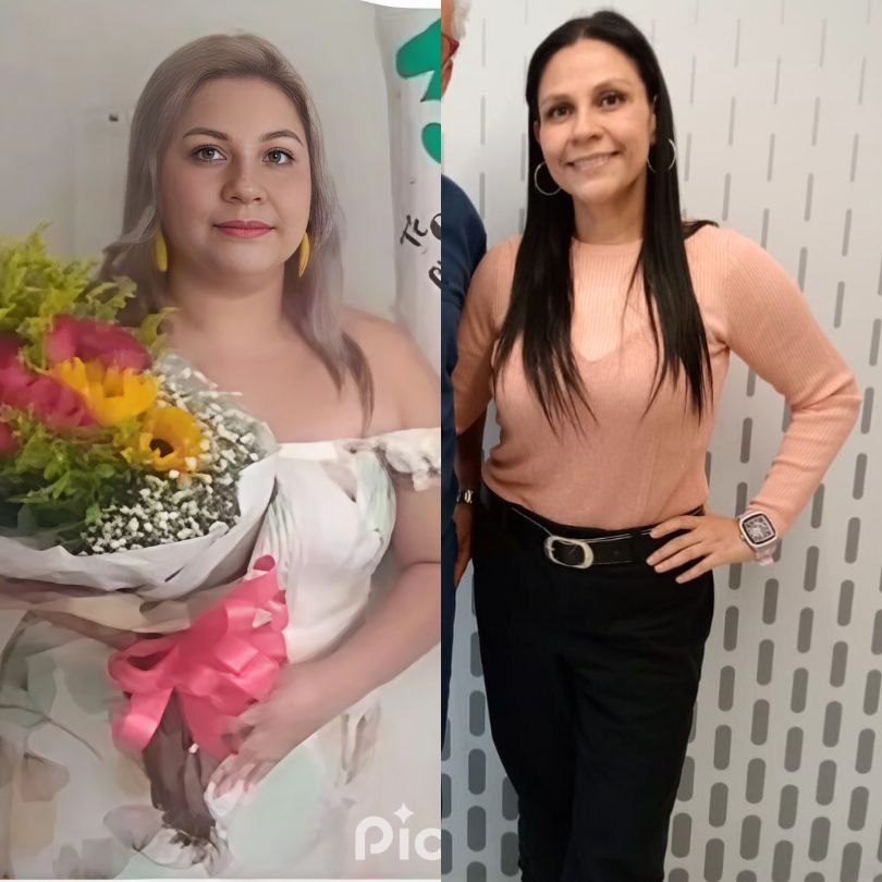 Antes y Después de Cirugía Bariátrica - Dr Rubén Luna Cirujano Bariátrico en Bogotá -ALT 5 (4)