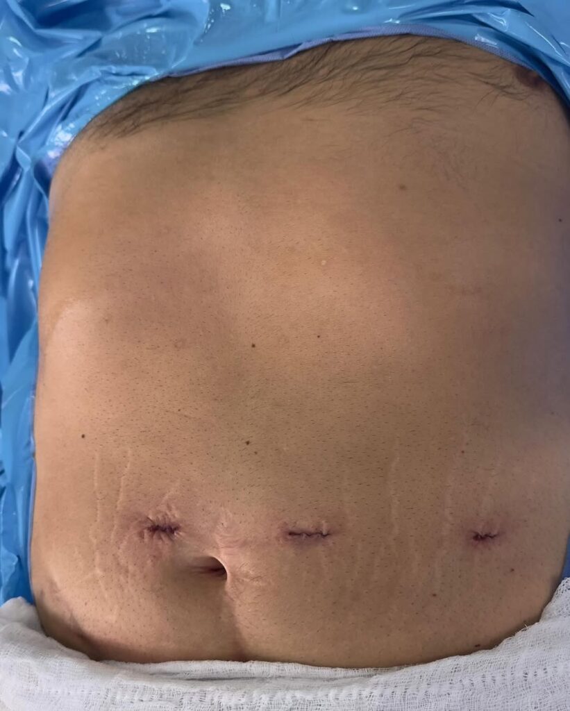 Foto de las cicatrices de una cirugía bariátrica robótica con 3 incisiones hecha en Colombia por el Dr. Rubén Luna