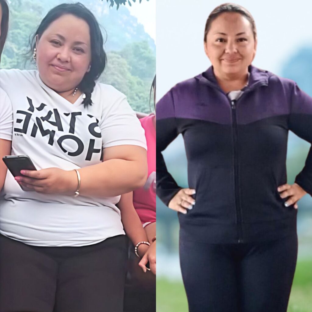 Antes y después de cirugía bariátrica en Bogotá con el Dr. Rubén Luna - 010825