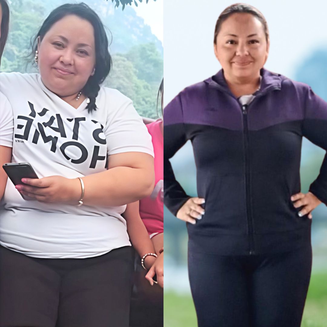 Antes y después de cirugía bariátrica en Bogotá con el Dr. Rubén Luna - 010825