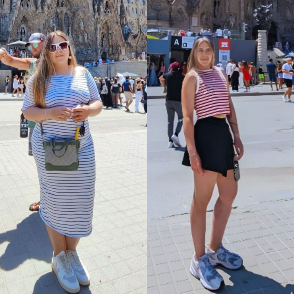 Antes y después de cirugía bariátrica en Bogotá con el Dr. Rubén Luna - 011025