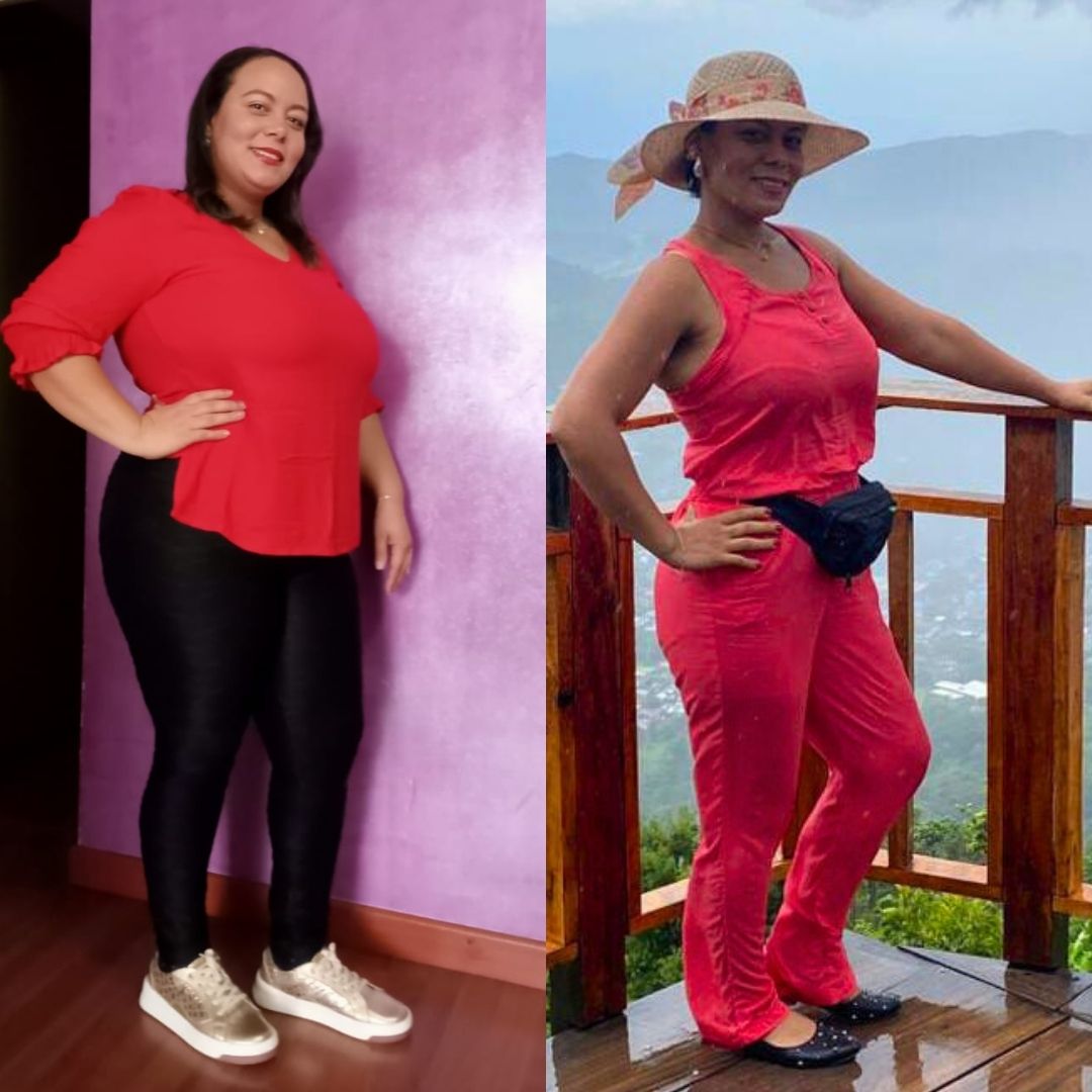 Antes y después de cirugía bariátrica en Bogotá con el Dr. Rubén Luna - 011025 2