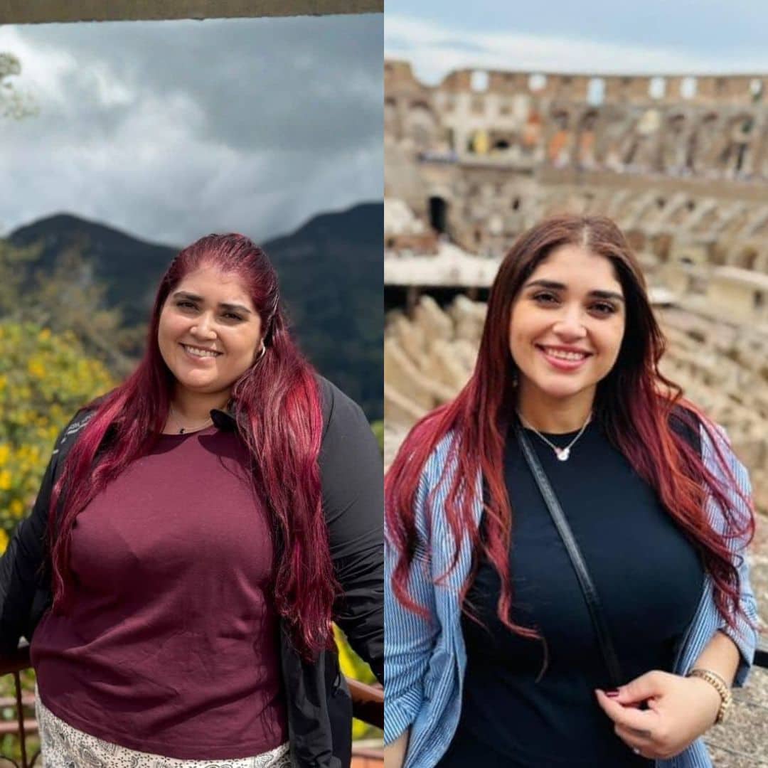 Antes y después de cirugía bariátrica en Bogotá con el Dr. Rubén Luna - 011225