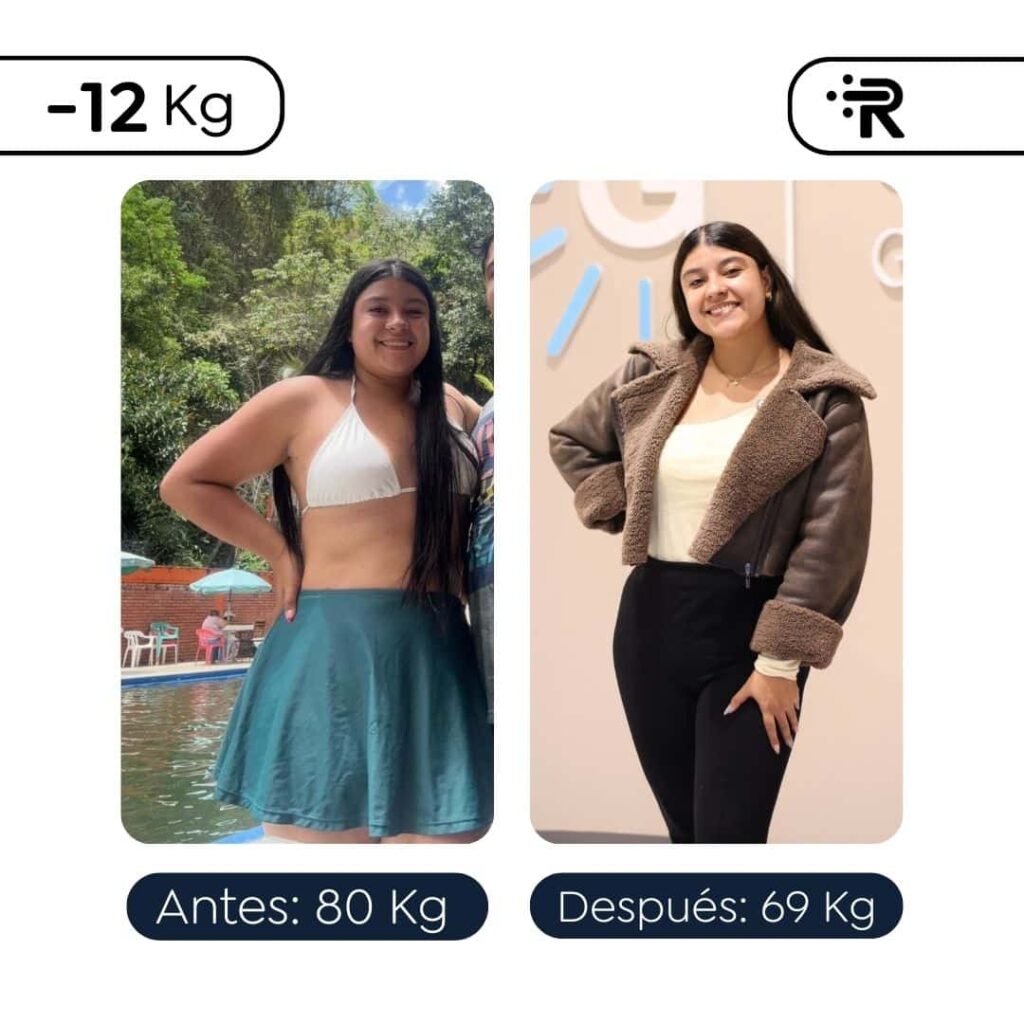 Antes y después de la manga gástrica - 1 mes posoperatorio en Bogotá