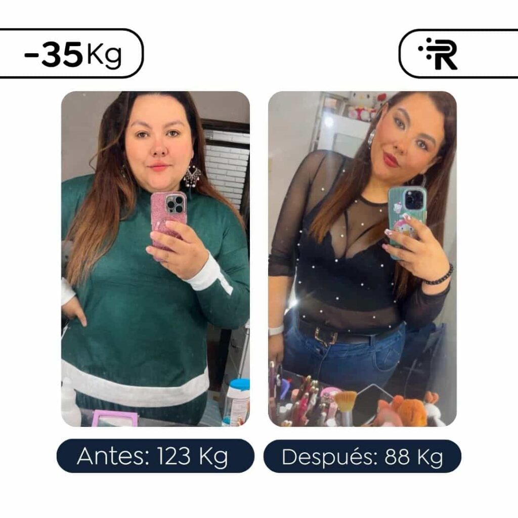 Antes y después de una Manga Gástrica - Dr.Rubén Luna -Cirujano Bariátrico en Medellín