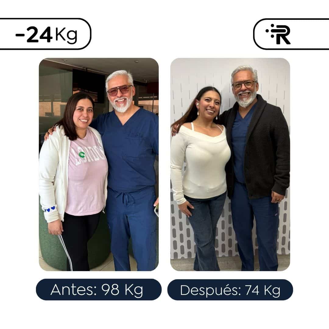 Antes y después de una cirugía bariátrica en Bogotá - Dr. Rubén Luna
