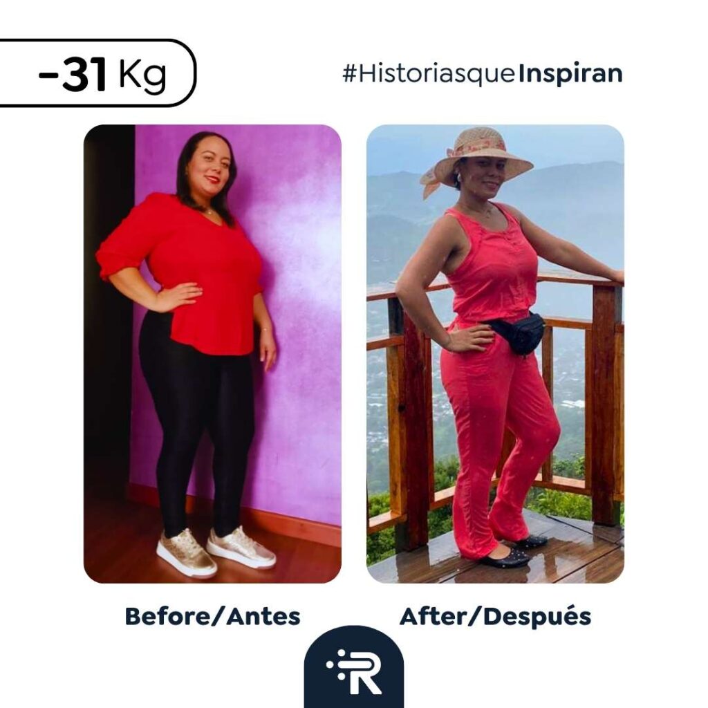 Cirugía bariátrica antes y después en Bogotá, Colombia - Dr. Rubén Luna 5