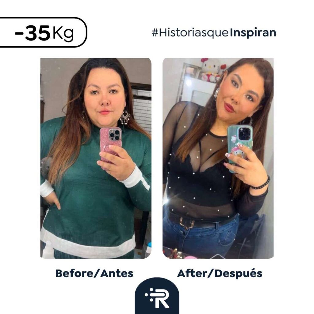 Cirugía bariátrica antes y después en Bogotá, Colombia - Dr. Rubén Luna 8