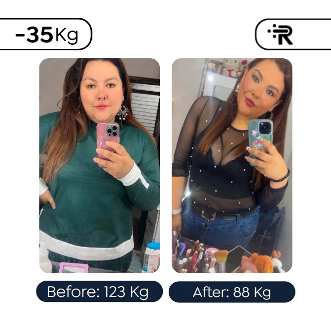 Robotic Bariatric Surgery-Dr. Rubén Luna