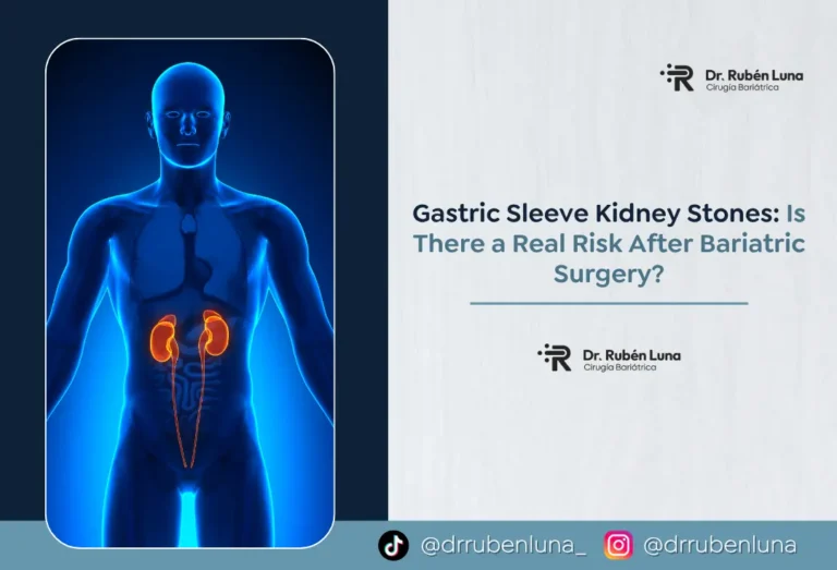 Gastric Sleeve Kidney Stones - Dr. Rubén Luna - Bogotá, Colombia