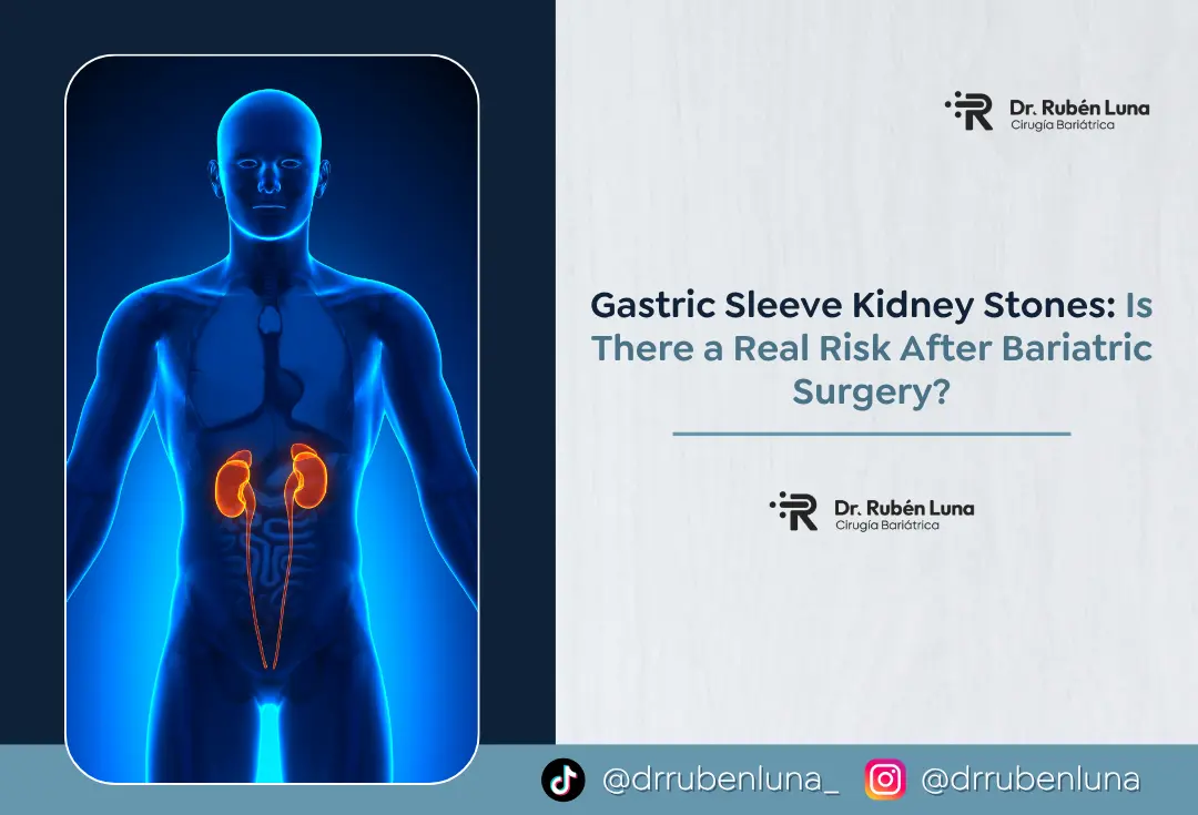 Gastric Sleeve Kidney Stones - Dr. Rubén Luna - Bogotá, Colombia