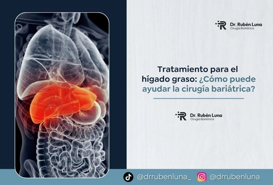 Tratamiento para el hígado graso cómo puede ayudar la cirugía bariátrica - Dr Ruben Luna
