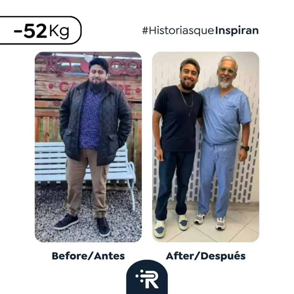 Weight loss before and after bariatric surgery with Dr. Rubén Luna — real patient result 10