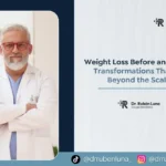 Weight loss Before and after- Dr. Ruben Luna