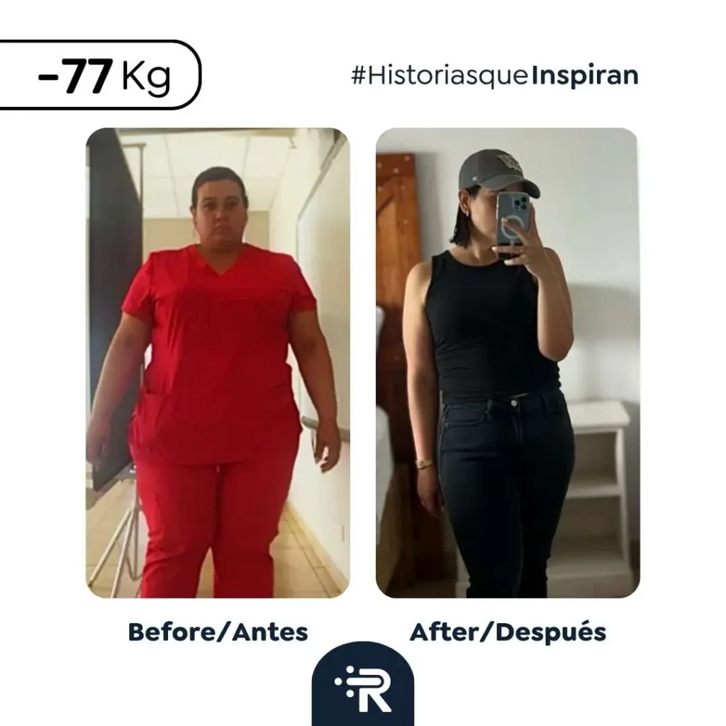 Weight loss before and after bariatric surgery with Dr. Rubén Luna — real patient result 5