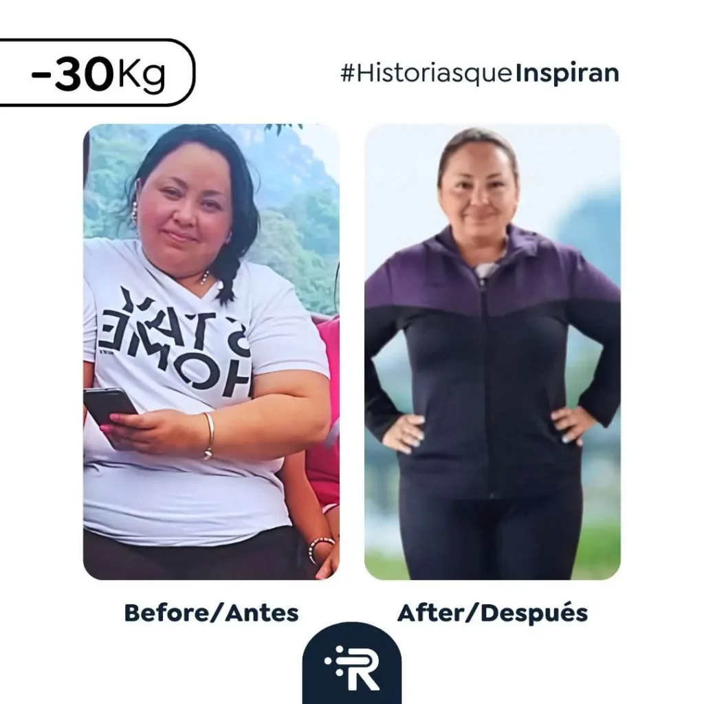 Weight loss before and after bariatric surgery with Dr. Rubén Luna — real patient result 6