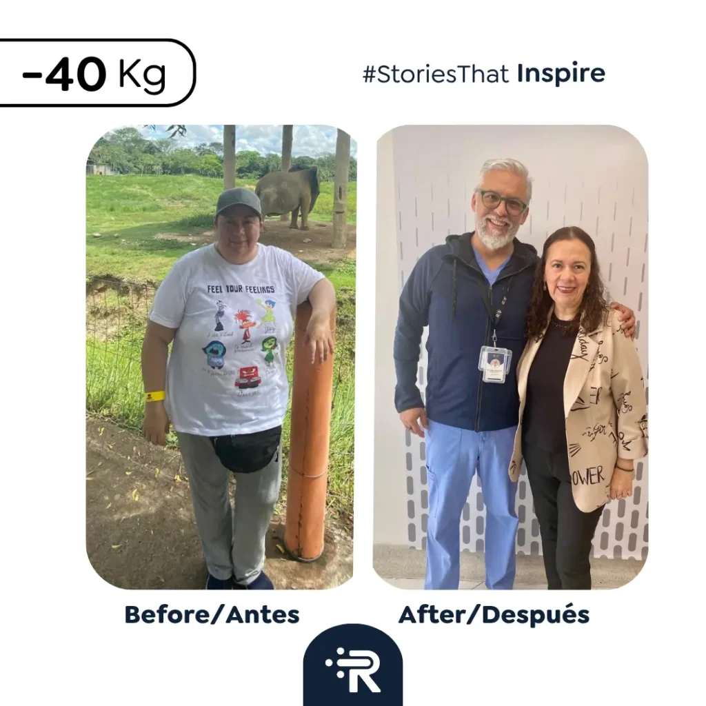 Before and After Bariatric Surgery Pic - Dr. Rubén Luna – Bogotá, Colombia