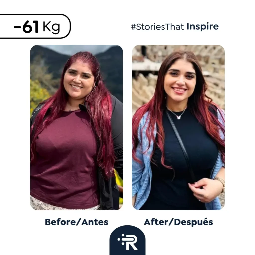 Before and After Bariatric Surgery Pic -Dr. Rubén Luna – Bogotá, Colombia
