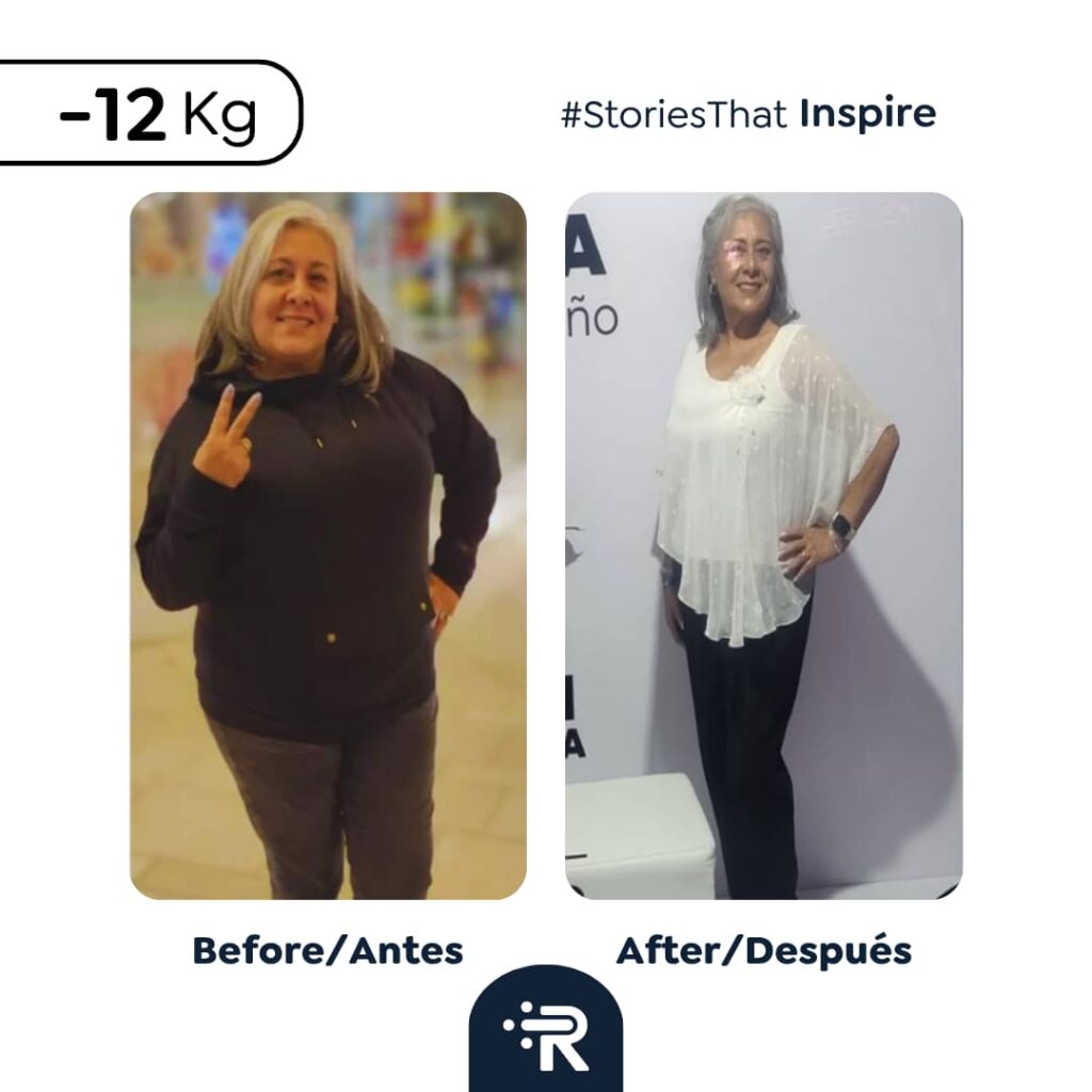Before and After Bariatric Surgery Pic - Success Stories – Dr. Rubén Luna – Bogotá, Colombia