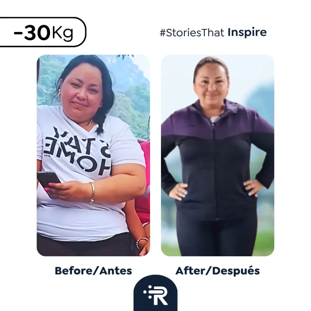 Before and After Bariatric Surgery Pic - Success Stories – Dr. Rubén Luna – Colombia