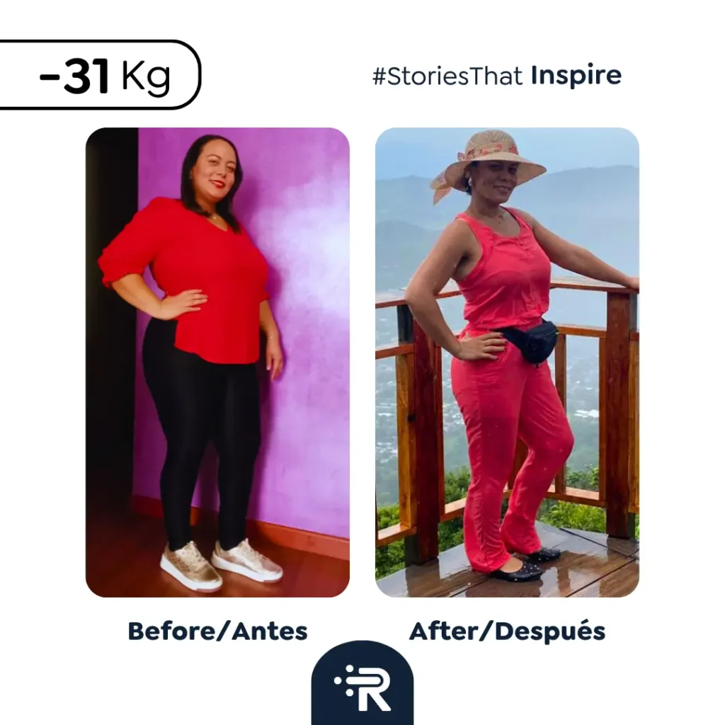 Before and After Bariatric Surgery Pics - Dr. Rubén Luna – Bogotá, Colombia