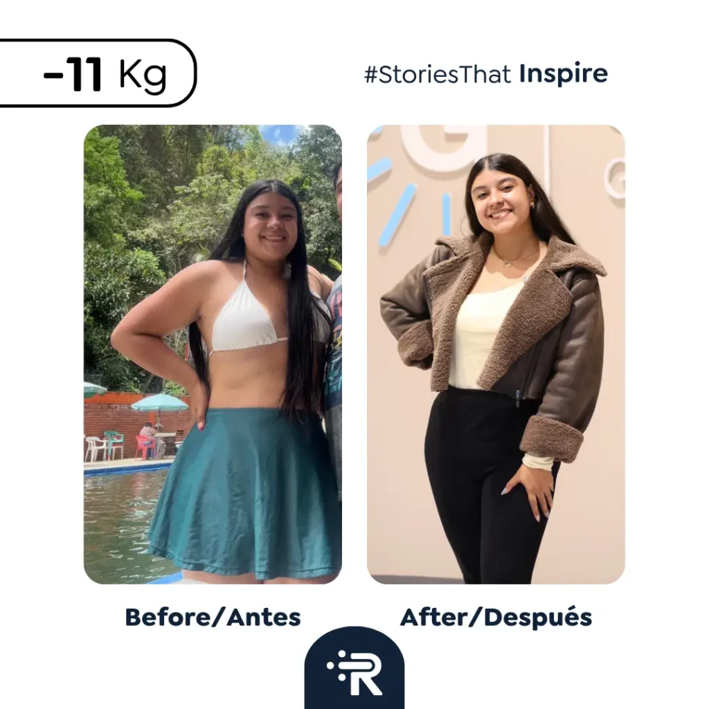 Before and After Bariatric Surgery Pics - Dr. Rubén Luna – Colombia