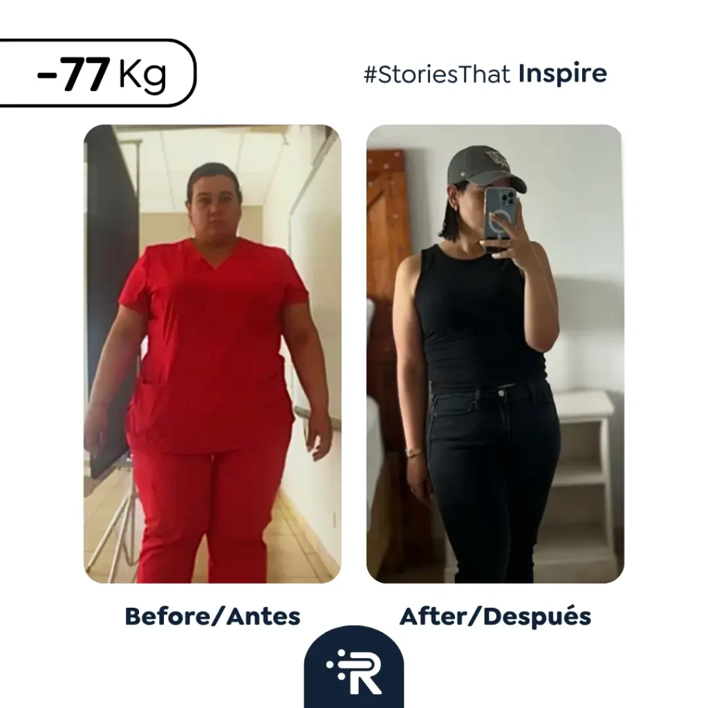 Before and After Bariatric Surgery Pics - Stories – Dr. Rubén Luna – Bogotá, Colombia