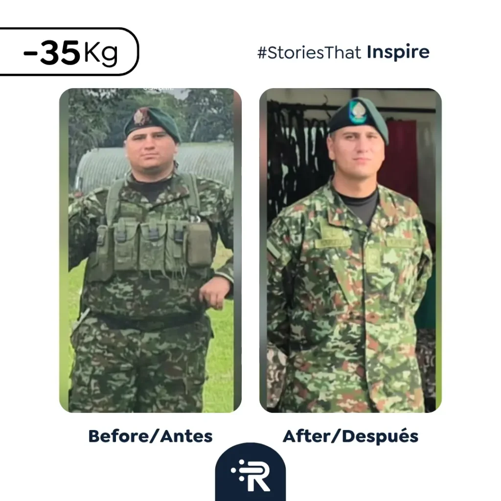 Before and After Bariatric Surgery Pics - Success Stories – Dr. Rubén Luna – Bogotá