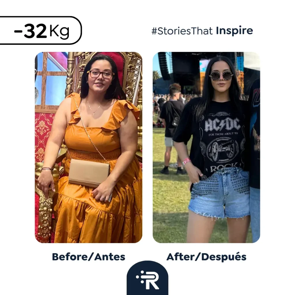 Before and After Bariatric Surgery Pics - Success Stories – Dr. Rubén Luna – Colombia