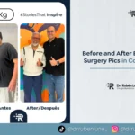 Before and After Bariatric Surgery Pics in Colombia - Dr. Rubén Luna - Bogotá