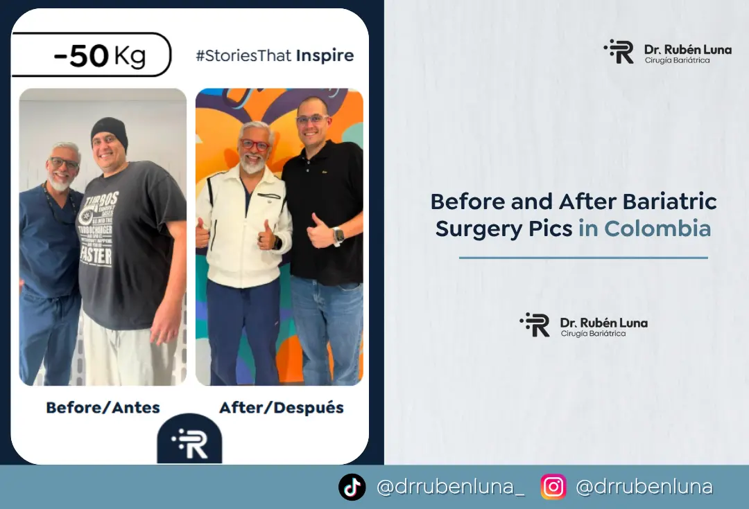 Before and After Bariatric Surgery Pics in Colombia - Dr. Rubén Luna - Bogotá