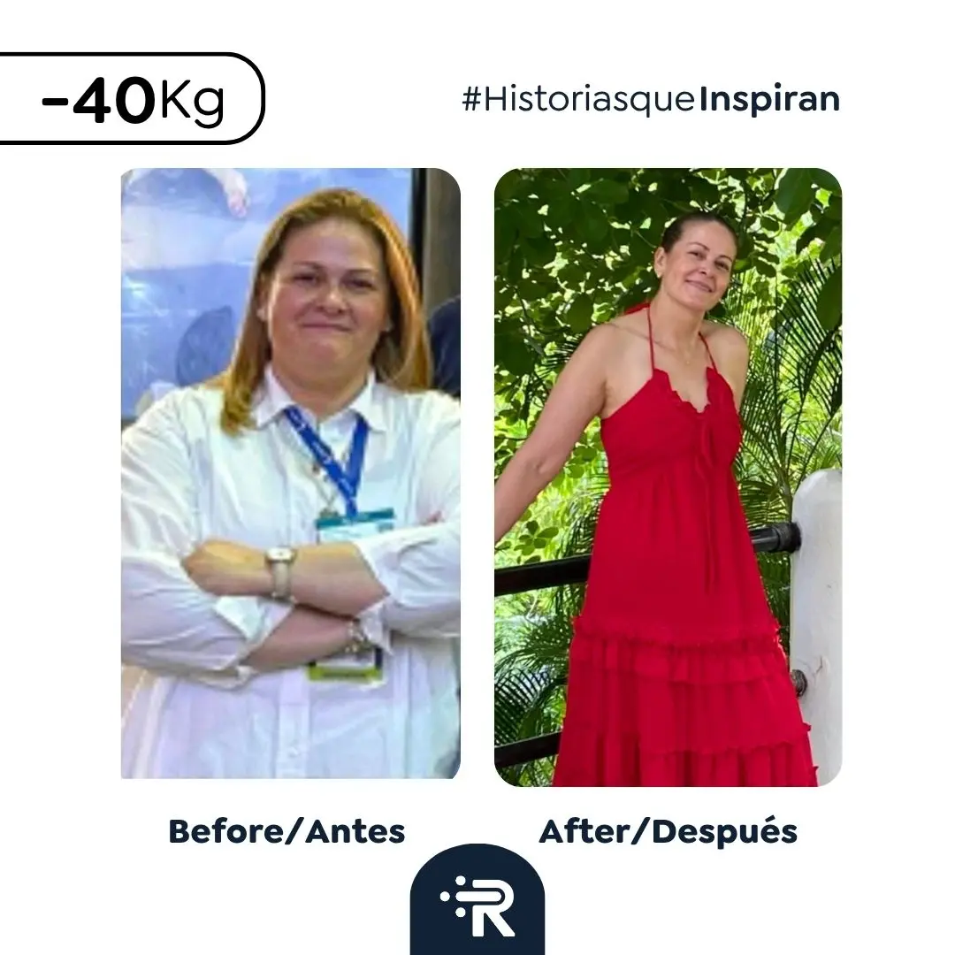 Cirugía bariátrica antes y después en Bogotá, Colombia - Dr. Rubén Luna - Manga gástrica - Bypass gástrico 03082026 1